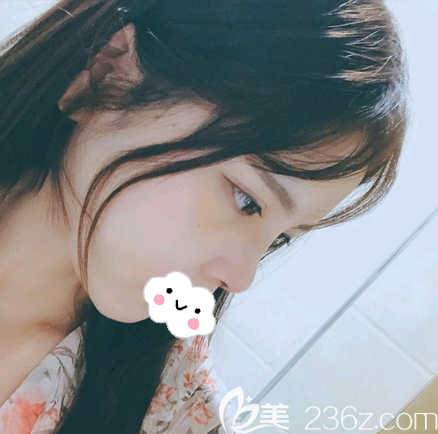 膨體隆鼻拆線后效果 膨體隆鼻拆線后效果