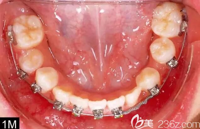 惠州致美口腔自鎖托槽矯正案例