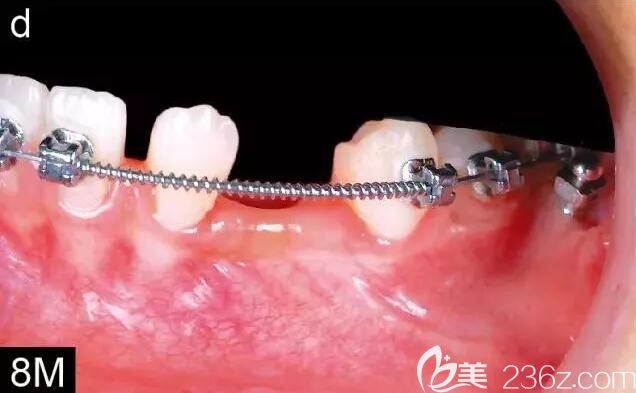 惠州致美口腔 Damon Q? 托槽矯正案例