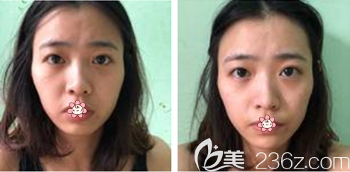 我術(shù)前 我術(shù)前