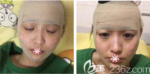 手術(shù)當(dāng)天 手術(shù)當(dāng)天