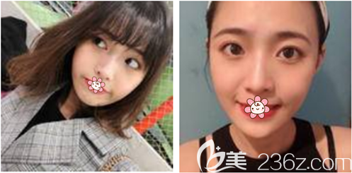 貴陽美萊做自體脂肪面部填充效果好不好 貴陽美萊做自體脂肪面部填充效果好不好