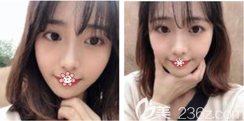 <!--<i data=20240703-sp></i>-->自體脂肪全臉填充術(shù)后2個(gè)月 <!--<i data=20240703-sp></i>-->自體脂肪全臉填充術(shù)后2個(gè)月