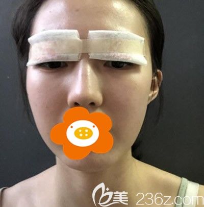 術(shù)后第二天眼上還貼著紗布