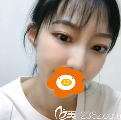 切開雙眼皮+開眼角術(shù)后半個月效果圖