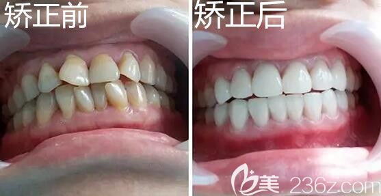 成都圣貝口腔牙齒矯正案例