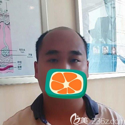 成都碧蓮盛植發(fā)術(shù)前 成都碧蓮盛植發(fā)術(shù)前