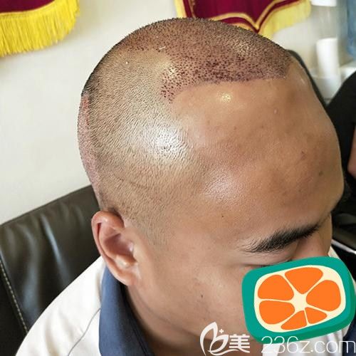 成都碧蓮盛植發(fā)術(shù)后即刻效果圖 成都碧蓮盛植發(fā)術(shù)后即刻效果圖