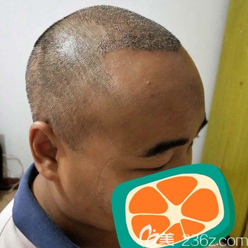 成都碧蓮盛頭頂加密種植術(shù)后5天 成都碧蓮盛頭頂加密種植術(shù)后5天