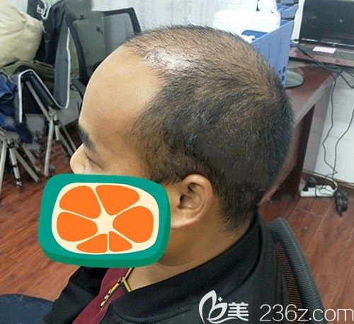 在成都碧蓮盛用SHT無痕種植技術(shù)植發(fā)際線加頭頂加密2500單位后改善了我的地中海發(fā)型