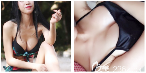 炫耀一下我找廣州藝美整形李闖院長做完假體自體脂肪復合隆胸躺下后的自然真實效果