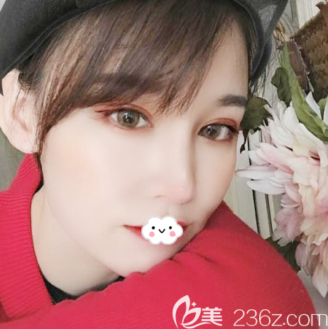 廣州藝美整形眼鼻脂肪填充一個月案例效果圖