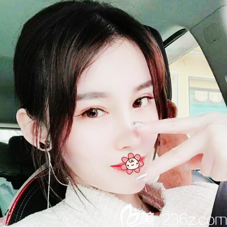 廣州藝美整形張濤雙眼皮隆鼻脂肪填充案例效果圖