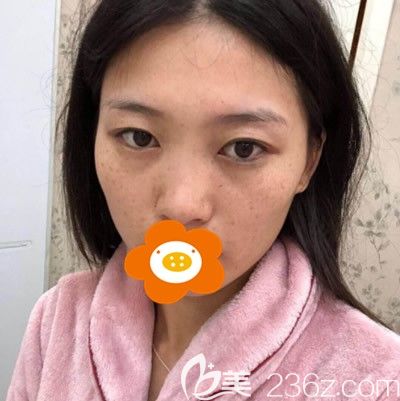 在泉州歐菲做隆鼻手術(shù)前的我 在泉州歐菲做隆鼻手術(shù)前的我