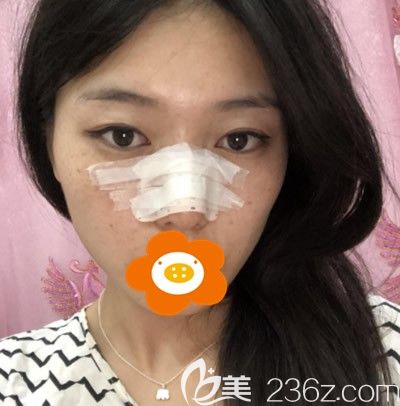 <!--<i data=20240703-sp></i>-->先主任為我做肋軟骨隆鼻手術(shù)后第3天 <!--<i data=20240703-sp></i>-->先主任為我做肋軟骨隆鼻手術(shù)后第3天