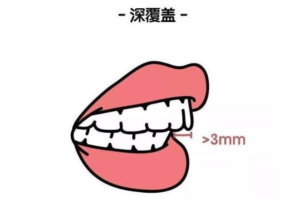 西諾口腔張瑤主任解析:27歲深覆蓋矯正要多久 西諾口腔張瑤主任解析:27歲深覆蓋矯正要多久