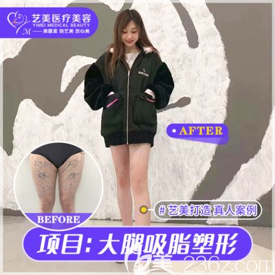 廣州藝美整形李向陽大腿吸脂案例