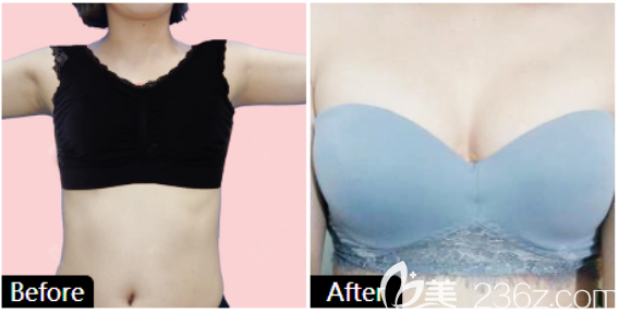 廣州藝美整形李向陽醫(yī)生隆胸案例