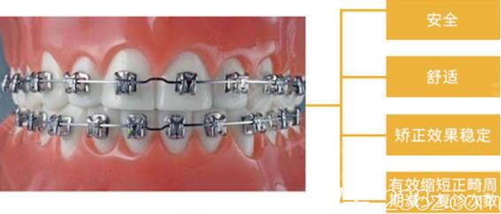 武漢壹加壹金屬自鎖托槽矯正優(yōu)勢(shì) 武漢壹加壹金屬自鎖托槽矯正優(yōu)勢(shì)
