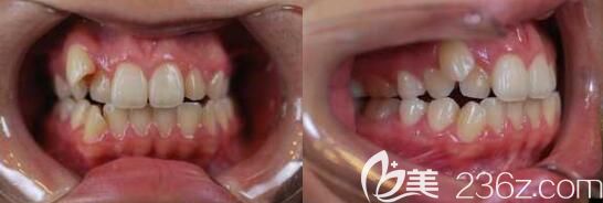 我在北京佳美口腔做虎牙矯正前的照片 我在北京佳美口腔做虎牙矯正前的照片