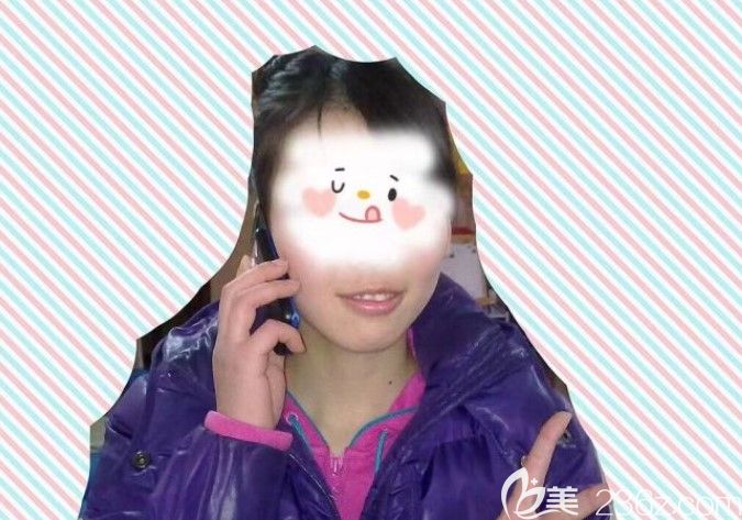 突嘴齙牙矯正前的照片 突嘴齙牙矯正前的照片