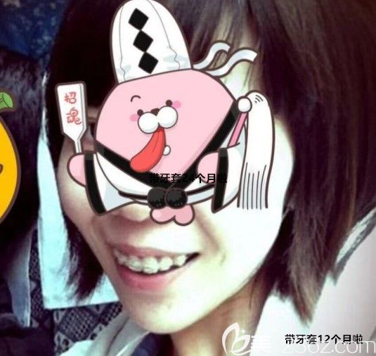 帶陶瓷半隱形牙套12個月 帶陶瓷半隱形牙套12個月