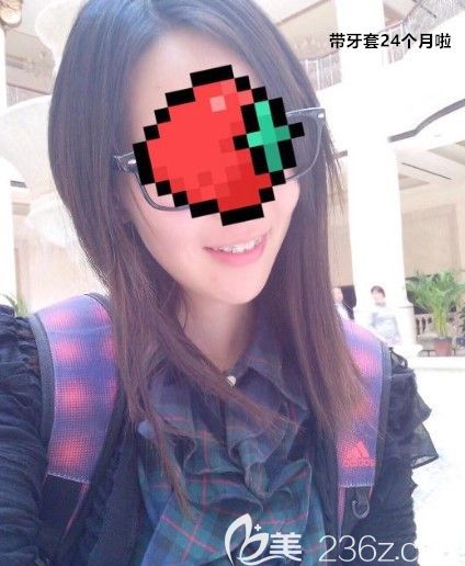 在西諾口腔矯正齙牙1年的效果圖 在西諾口腔矯正齙牙1年的效果圖