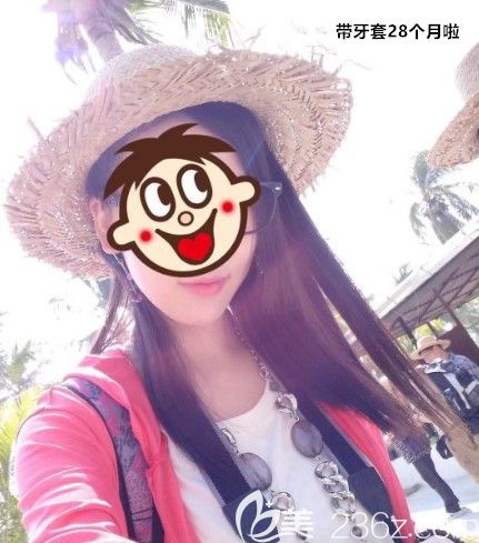 突嘴齙牙在北京西諾口腔戴陶瓷半隱形牙套矯正28個(gè)月，親身經(jīng)歷驗(yàn)證正畸可以改善嘴凸不