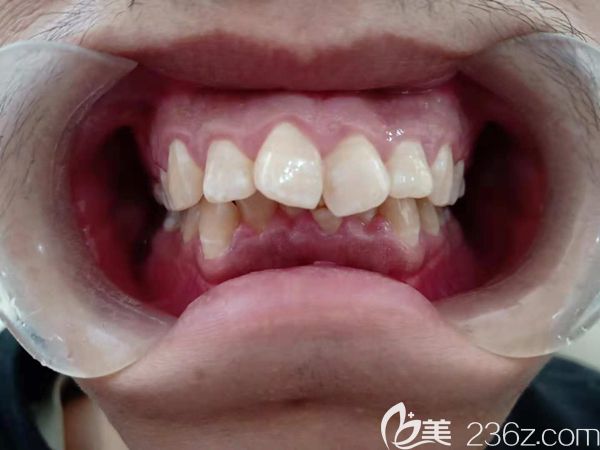 前牙深覆蓋牙齒圖示