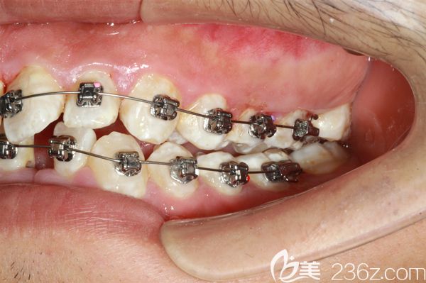 金屬自鎖托槽矯正牙齒圖