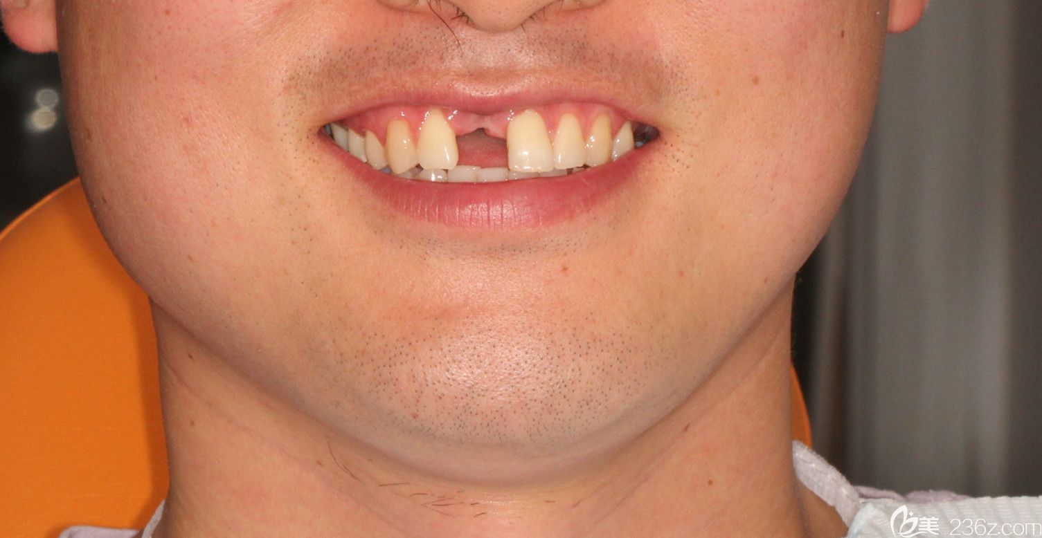 種牙前的照片 種牙前的照片