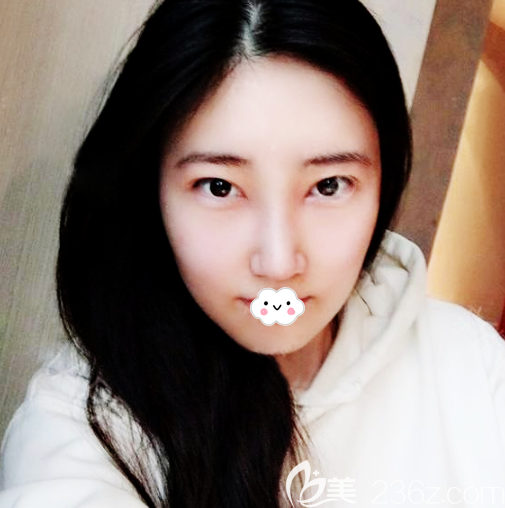 深圳整鼻子很出名的羅志敏醫(yī)生隆鼻案例20天效果 深圳整鼻子很出名的羅志敏醫(yī)生隆鼻案例20天效果