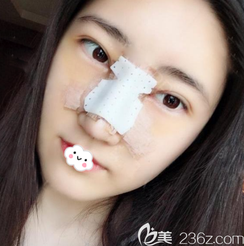 深圳厲害的隆鼻醫(yī)生羅志敏隆鼻案例6天效果 深圳厲害的隆鼻醫(yī)生羅志敏隆鼻案例6天效果