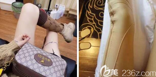 武漢壹加壹醫(yī)療美容醫(yī)院李艷東主任給我做水動力大腿吸脂術后2個月恢復過程圖