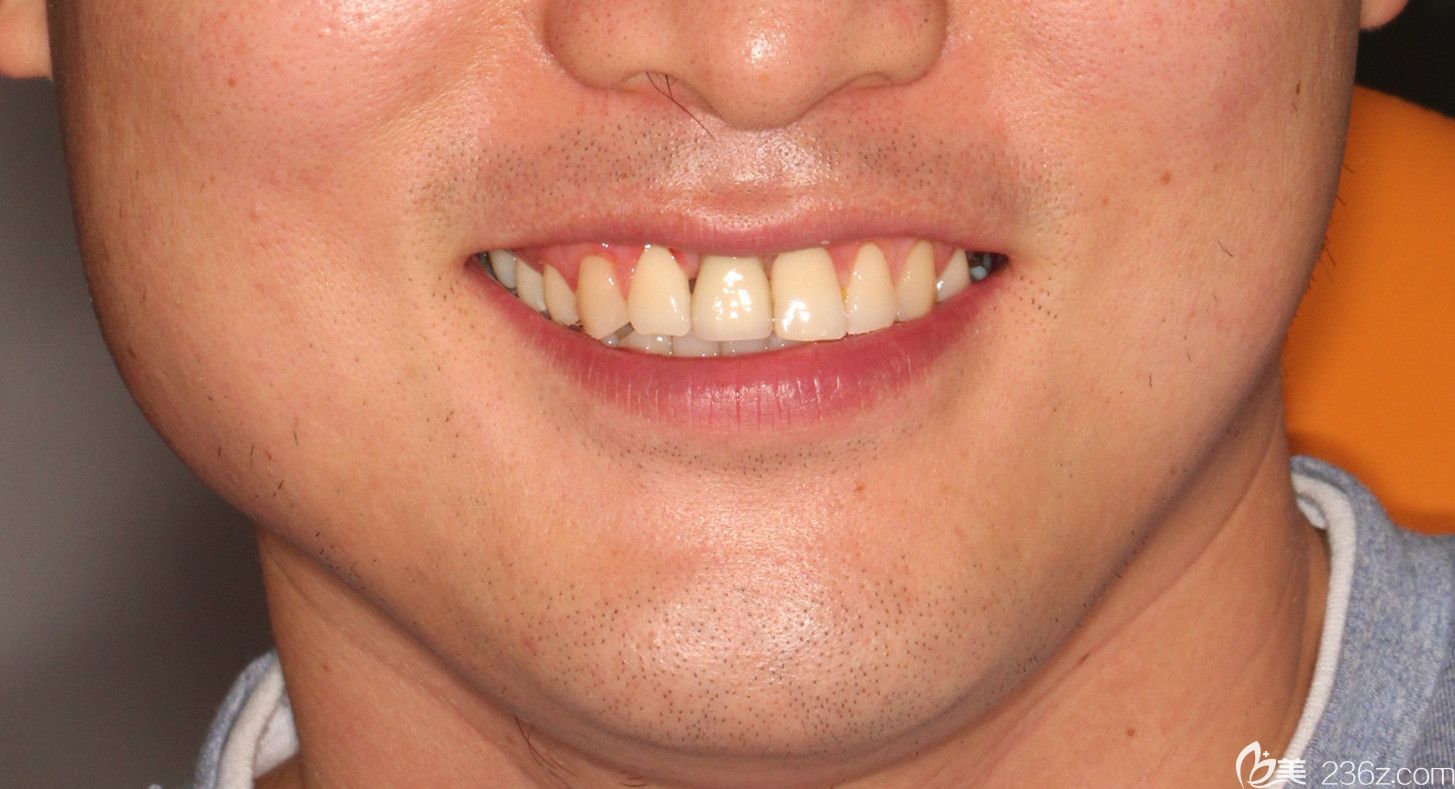 門牙缺失一顆能做瑞典nobel種植牙，有我在廣州陽光樹口腔的種牙案例為證