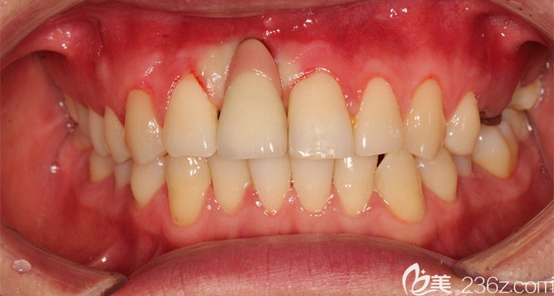 種植牙中的照片 種植牙中的照片