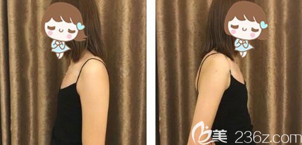 在南寧美麗焦點(diǎn)隆胸手術(shù)前 在南寧美麗焦點(diǎn)隆胸手術(shù)前