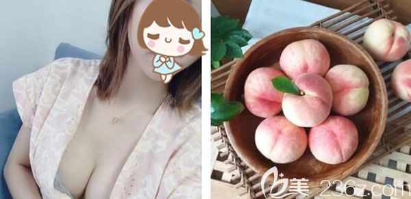 找焦俊光院長(zhǎng)做脂肪豐胸一個(gè)月的效果圖 找焦俊光院長(zhǎng)做脂肪豐胸一個(gè)月的效果圖