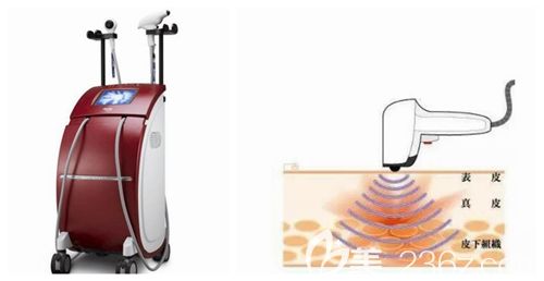 洛陽華美熱拉提效果 洛陽華美熱拉提效果