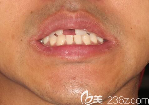 門牙缺失在廣州陽光樹口腔種牙前照片 門牙缺失在廣州陽光樹口腔種牙前照片