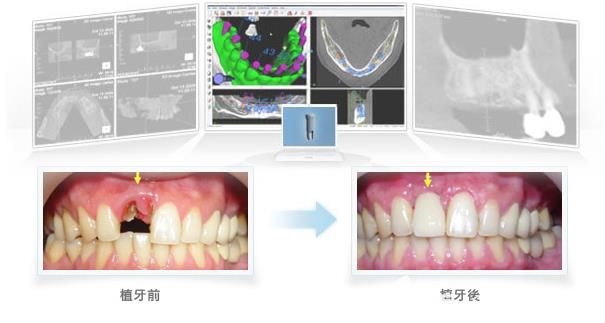 深圳徠可口腔種植牙