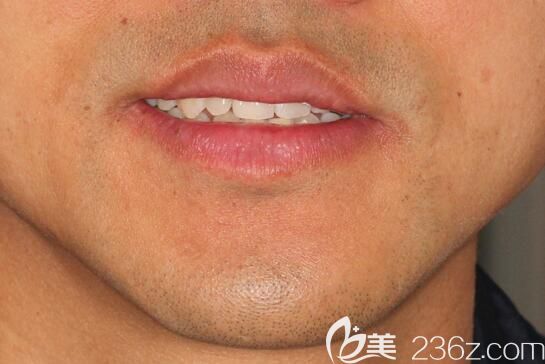 天啊!80后小哥門牙缺失在廣州陽光樹口腔做韓國登騰即刻種植牙來透露效果和價格啦