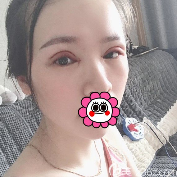 剛做完雙眼皮的樣子