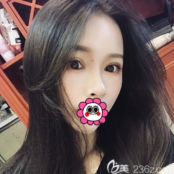 杭州維多利亞俞國(guó)寶為我做的開(kāi)扇雙眼皮得到了很多人的夸獎(jiǎng)