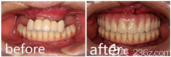 黎醫(yī)生做穿顴種植手術前后對比圖