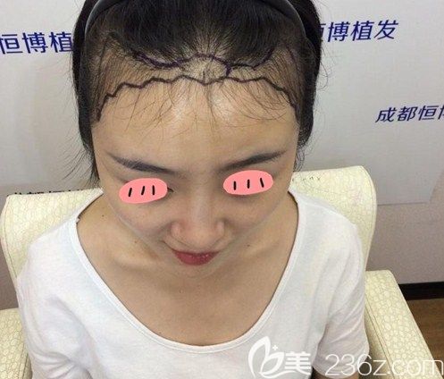 成都城恒博發(fā)際線種植 成都城恒博發(fā)際線種植