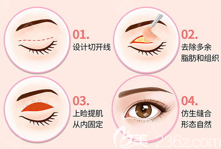 深圳南雅整形醫(yī)院張燕發(fā)雙眼皮手術(shù)分解圖 深圳南雅整形醫(yī)院張燕發(fā)雙眼皮手術(shù)分解圖