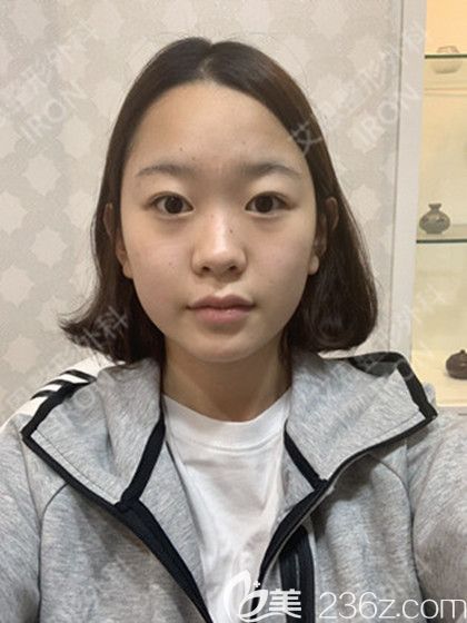 艾恩整形術前生活照 艾恩整形術前生活照