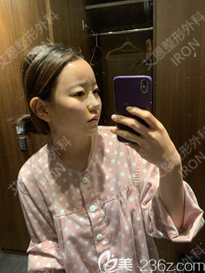 艾恩整形術后當天 艾恩整形術后當天