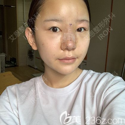 艾恩整形術后第3天 艾恩整形術后第3天